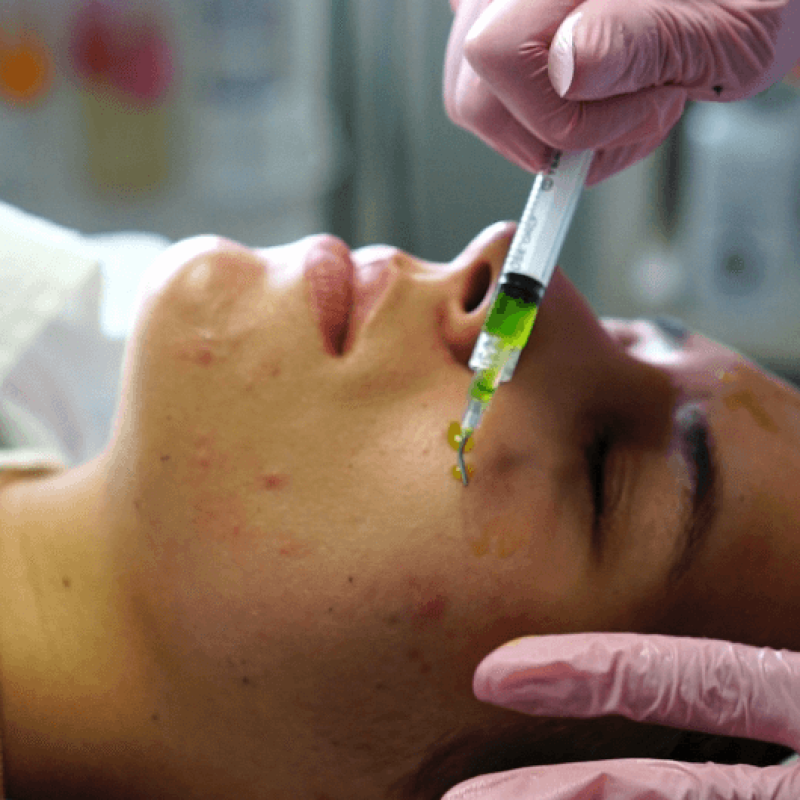 Despre Noi 8 din timpul tratamentului cu biorepeel clinica alteo bistrita